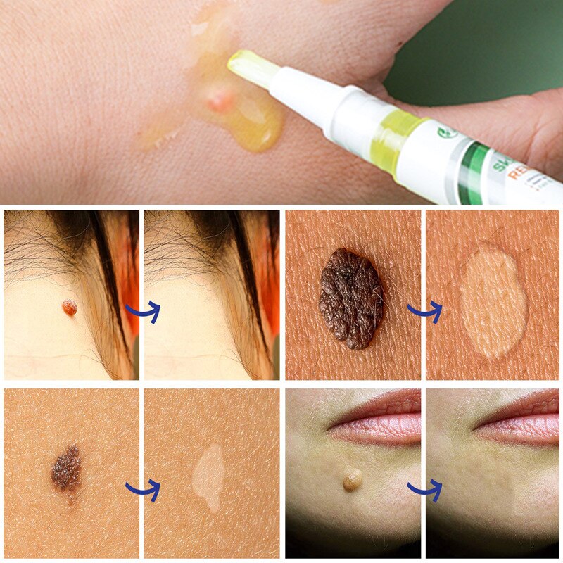 SKIN TAG REMOVER